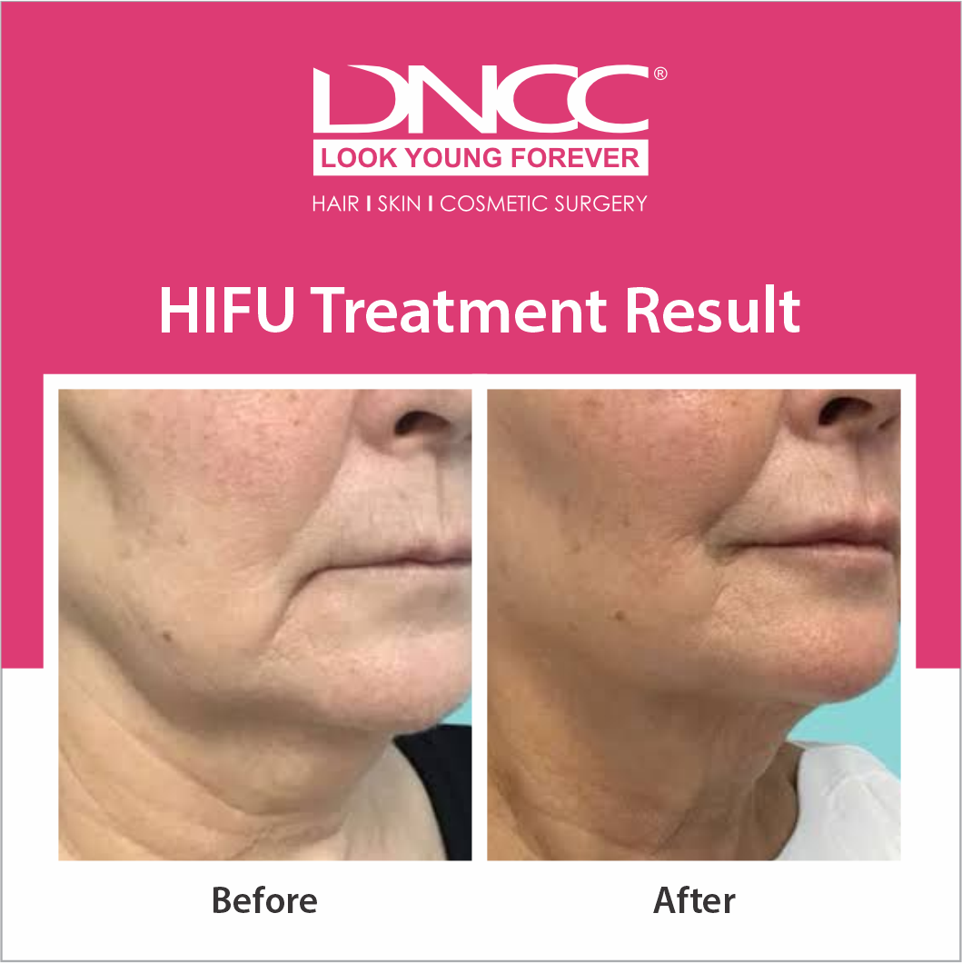 Hair Transplant Transformation 1
